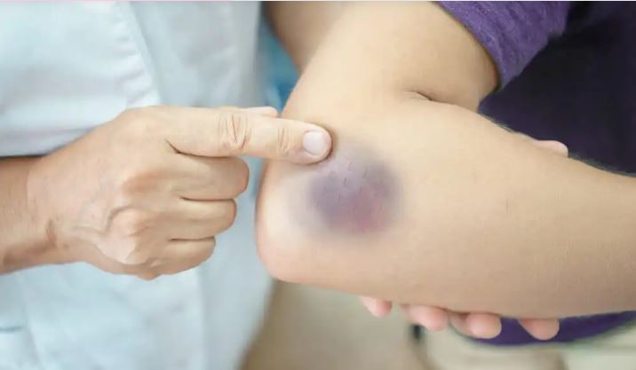 Tragedy in Maldonado: A child dies from purpura fulminans in San Carlos 4 A child who died of purpura fulminans in San Carlos, Uruguay, has triggered a health alert and prevention protocols in Maldonado.