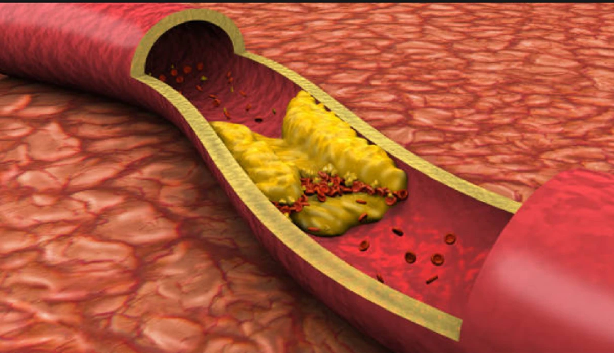 El colesterol LDL puede elevarse por causas genéticas incluso con buena alimentación.