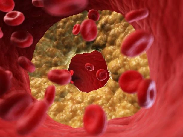 Científicos identifican variantes hereditarias que aumentan el colesterol LDL y el riesgo cardíaco.