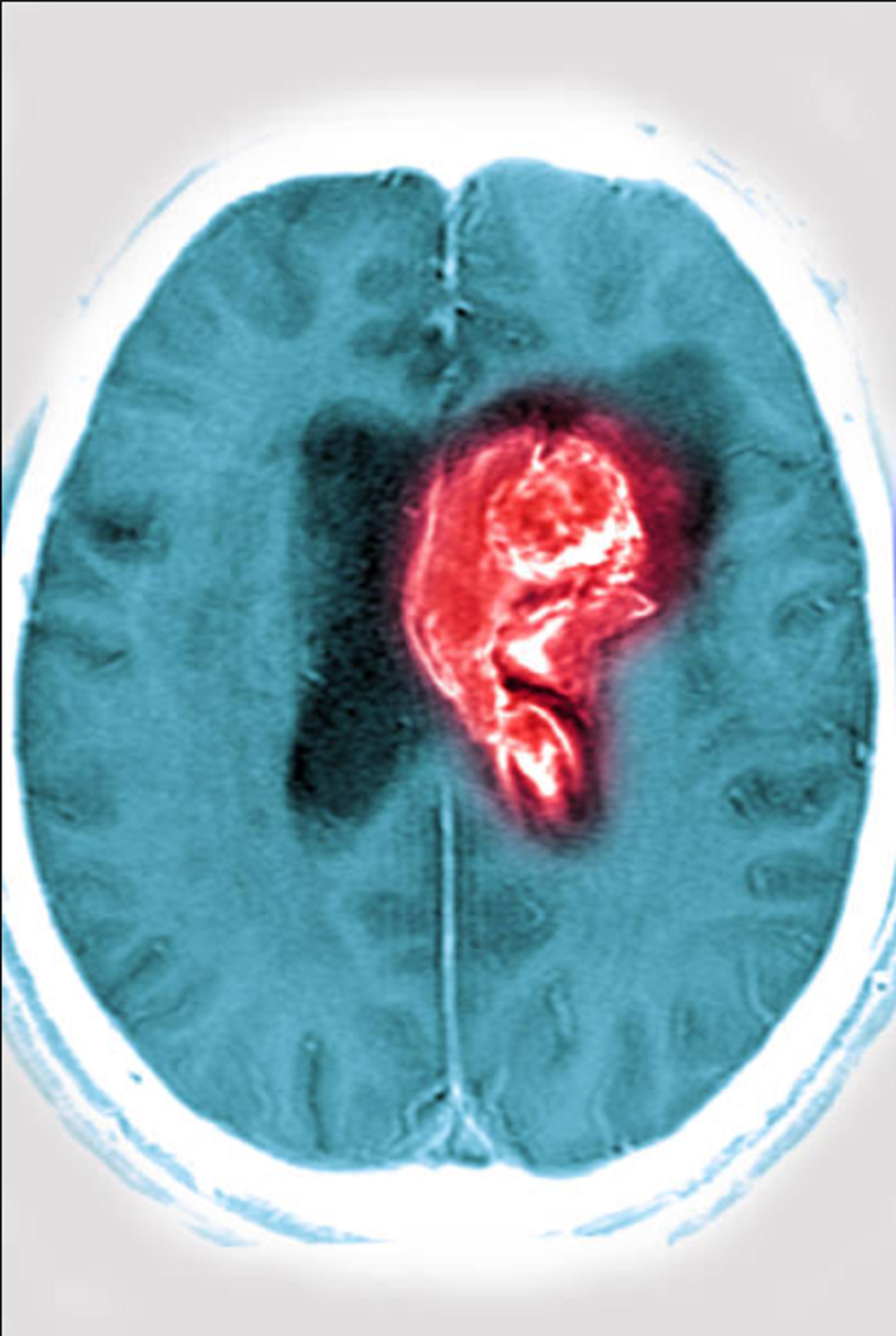 Los cinco síntomas de ACV que exigen atención médica urgente, según el Dr. Linazasoro 5 La debilidad corporal y los cinco síntomas de ACV