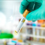 Vigilancia de hepatitis B en Uruguay