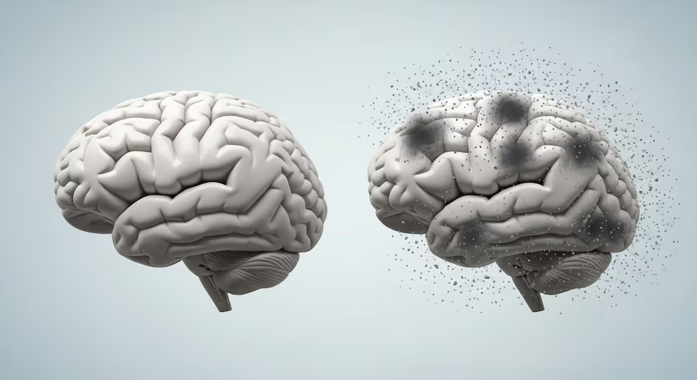 Atrofia cerebral por demencia frontotemporal