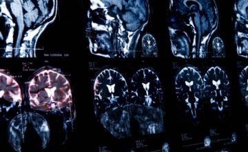 En Yucatán, el cuerpo de agua contaminado por Naegleria fowleri fue identificado como origen de una infección cerebral rara tras el fallecimiento de un adulto en Mérida.