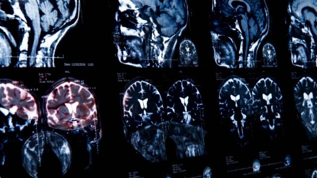En Yucatán, el cuerpo de agua contaminado por Naegleria fowleri fue identificado como origen de una infección cerebral rara tras el fallecimiento de un adulto en Mérida.