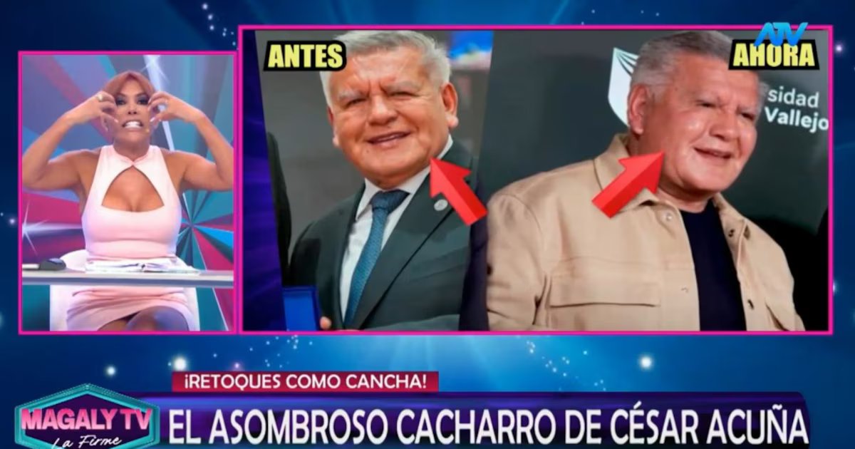 César Acuña recibe críticas por sus cambios faciales y Magaly Medina lo califica de «monstruosidad»
