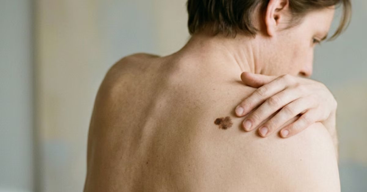 Identifica cuándo consultar a un dermatólogo por un lunar y cómo protegerse del riesgo de cáncer de piel ante la exposición a la radiación ultravioleta elevada