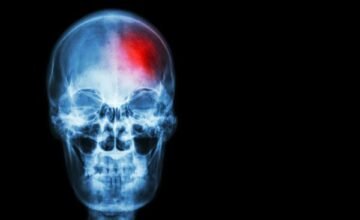 Un estudio en ratones revela que ciertos metabolitos generados por bacterias intestinales influyen en la respuesta inmune y el daño cerebral tras un Ictus, mostrando una conexión.