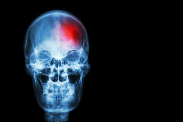 Un estudio en ratones revela que ciertos metabolitos generados por bacterias intestinales influyen en la respuesta inmune y el daño cerebral tras un Ictus, mostrando una conexión.