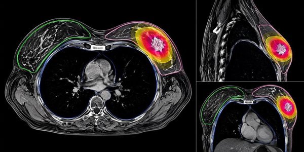 El Consejo Interterritorial aprueba los criterios de acceso a la protonterapia en el Sistema Nacional de Salud